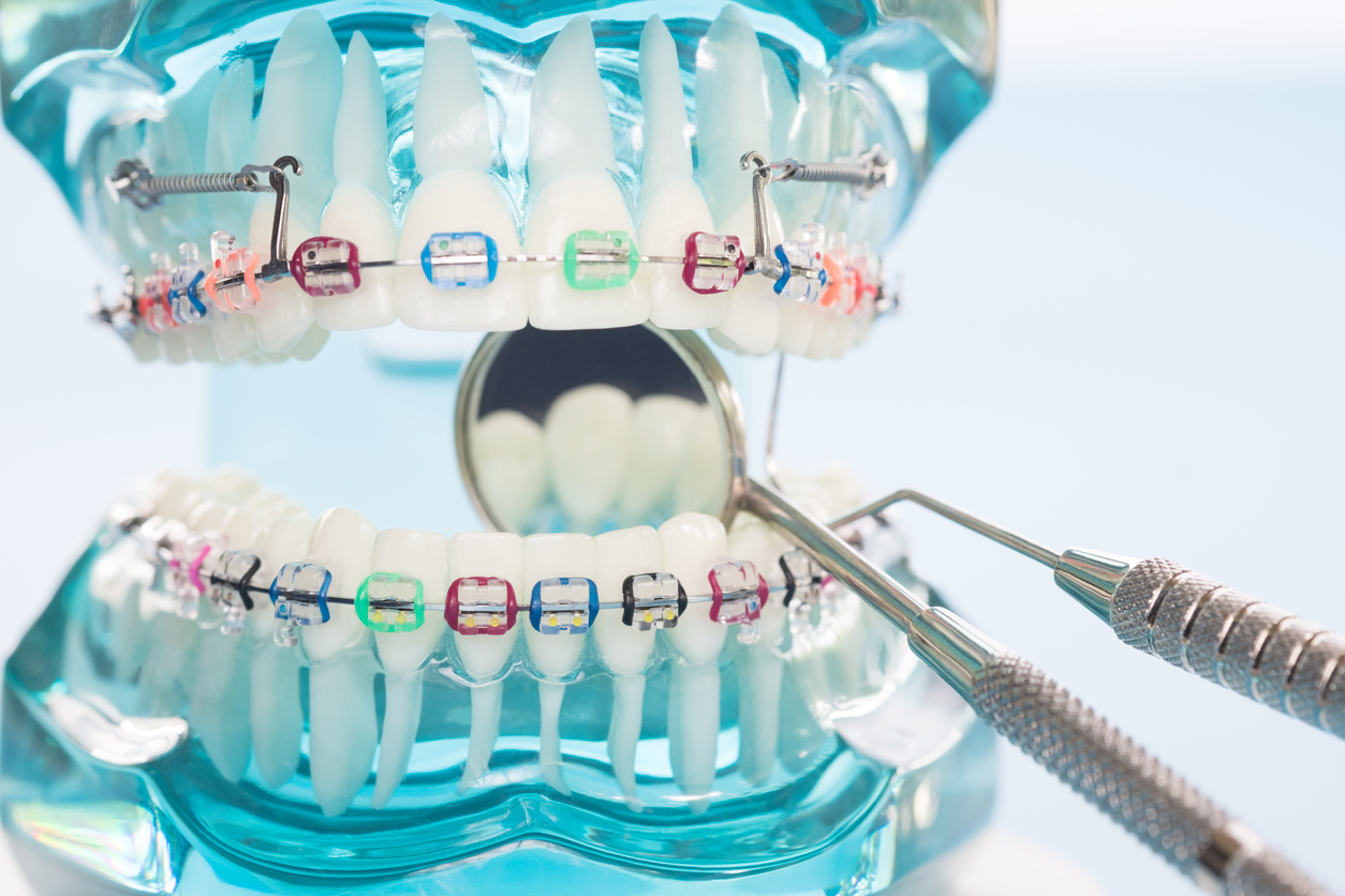 Orthodontie - Les minivis d'ancrage 2